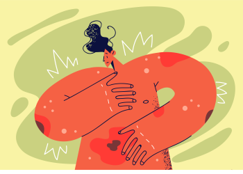 7 dalykai, kuriuos spalvoti žmonės turėtų žinoti apie Hidradenitis Suppurativa