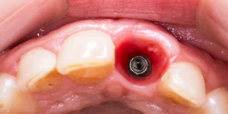 Mitai apie dantų implantus